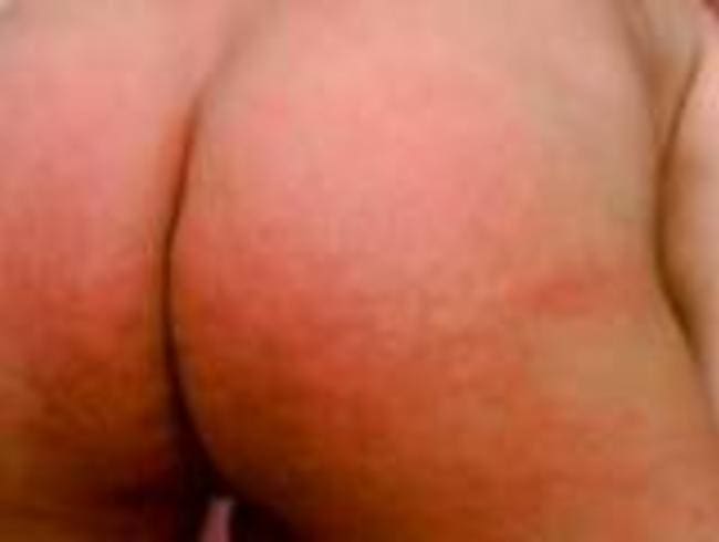 Spuren des Brennessel Spanking´s